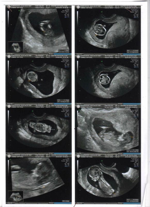 What is a nuchal scan