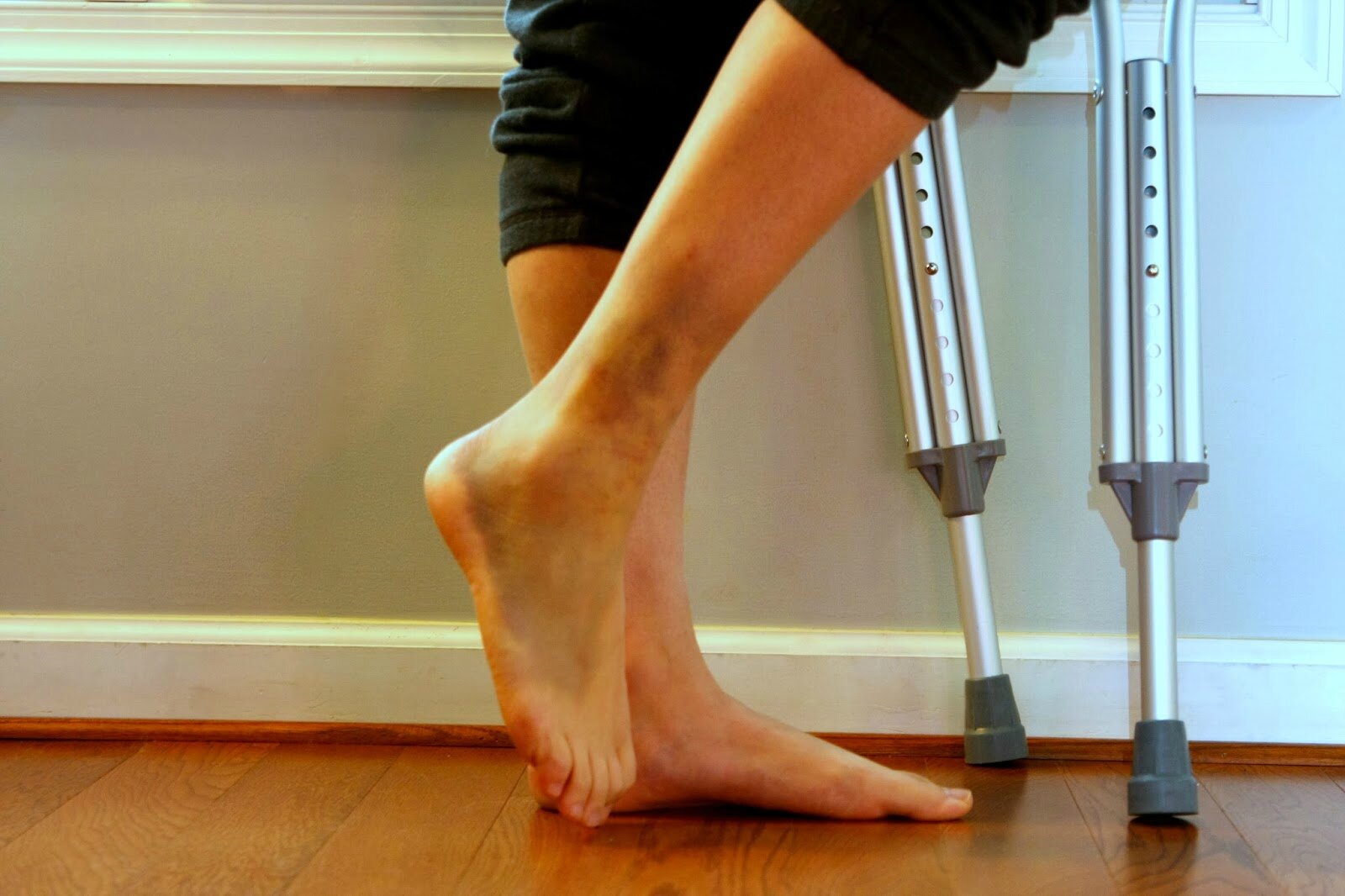  Sprained ankle, crutches and footbare